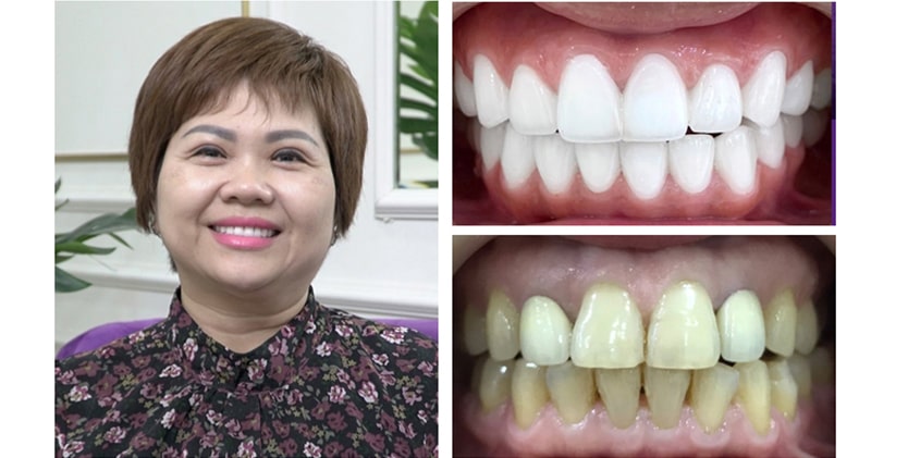 Những điều cần biết về bọc răng sứ