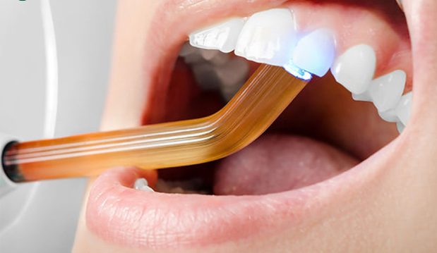 Trám răng thẩm mỹ - Phương pháp phục hình thẩm mỹ