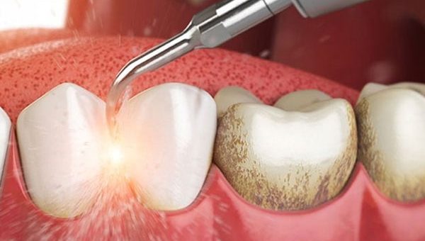 Thực hiện cao vôi răng, loại bỏ mảng bám gây bệnh răng miệng
