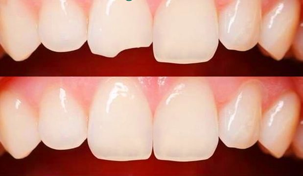 Răng vỡ mẻ cũng có thể sử dụng phương pháp trám răng thẩm mỹ
