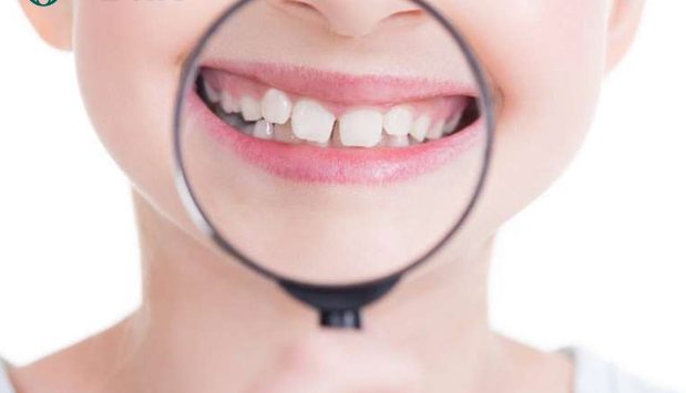 Một số lưu ý khi nhổ răng sữa cho trẻ tại nhà