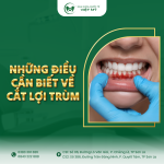 NHUNG-DIEU-CAN-BIET-VE-CAT-LOI-TRUM