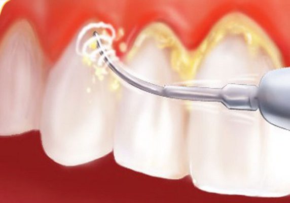 Lấy cao răng thường xuyên cho răng miệng khỏe mạnh
