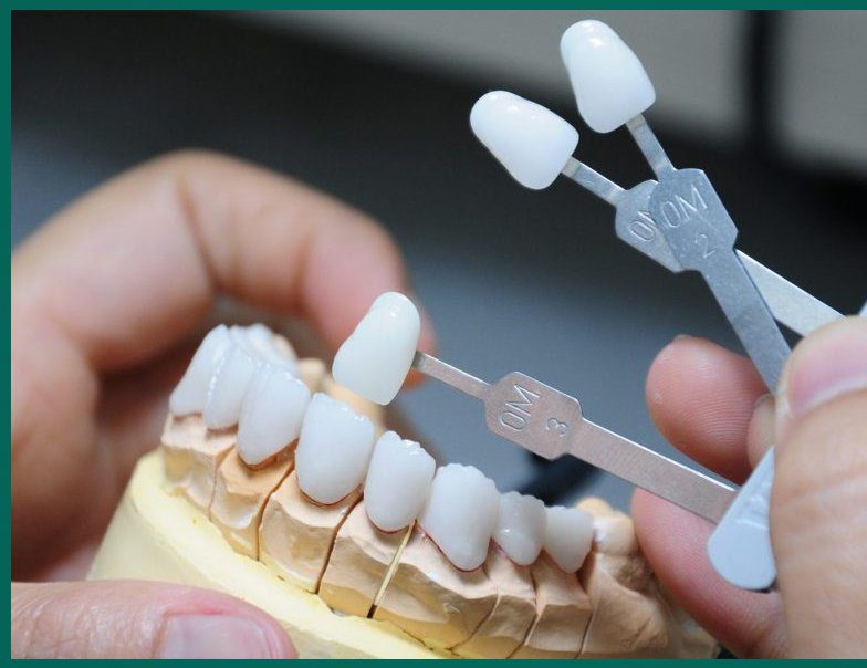 Thực hiện bọc sứ toàn hàm giúp bạn sở hữu nụ cười trắng đều tự nhiên