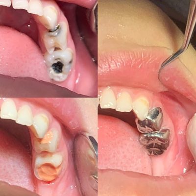 Chụp răng thép cho bé để phục hồi răng bị sâu