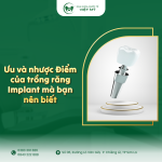 Ưu và nhược điểm của trồng răng Implant mà bạn nên biết – Nha khoa Quốc Tế Việt Mỹ uu-nhuoc-diem-cua-trong-rang-implant-ma-ban-nen-biet